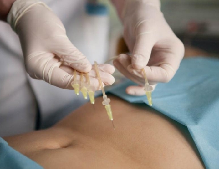 Озонотерапия - Оздоровительные услуги - Санаторий «Источник» Ессентуки